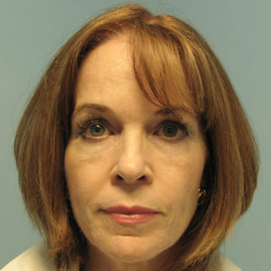 Botox After - Forehead and Eyes