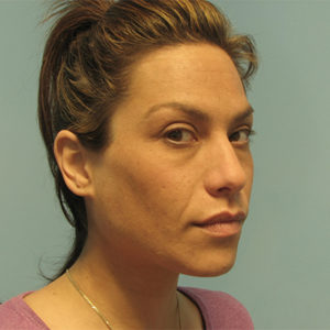 Juvederm before picture