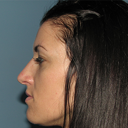 Rhinoplasty after picture