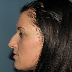 Rhinoplasty before picture